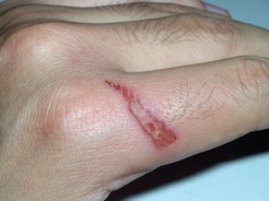 Una mano herida por falta de protección